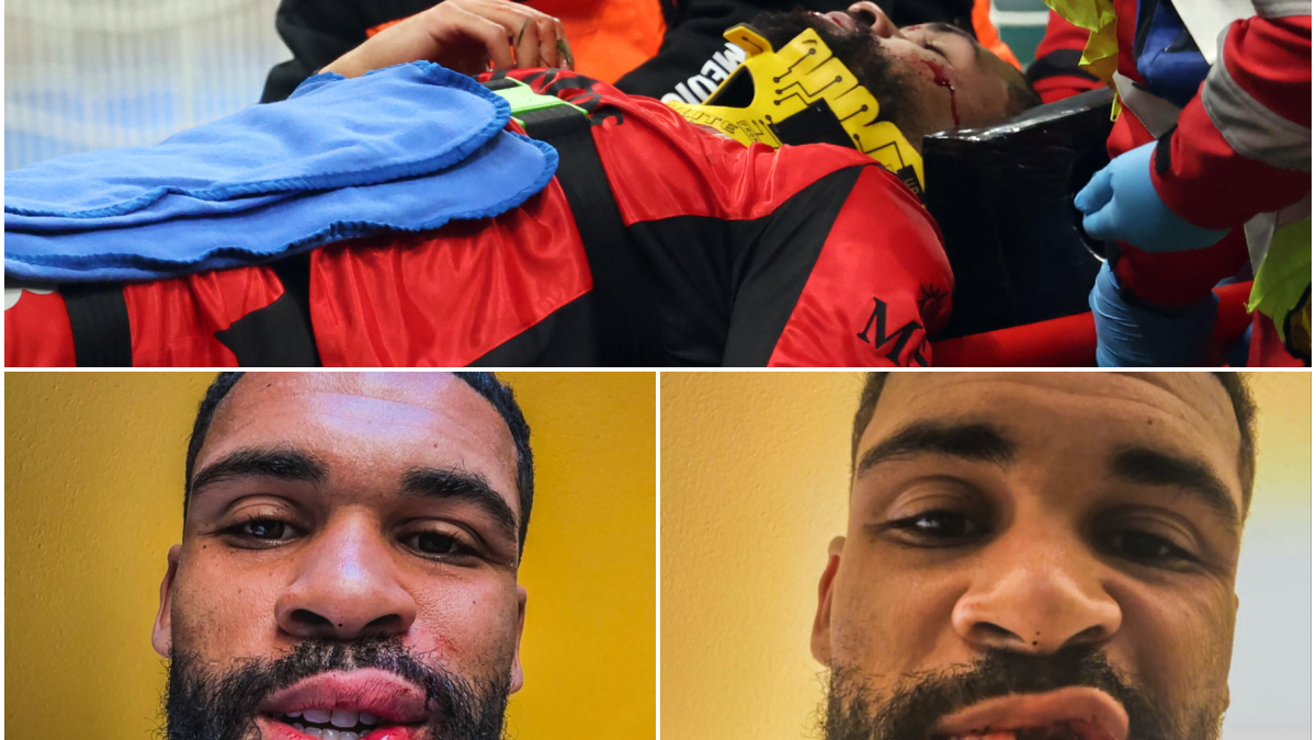 Il giocatore del Milan Loftus-Cheek fuori per due mesi a causa della frattura della mascella